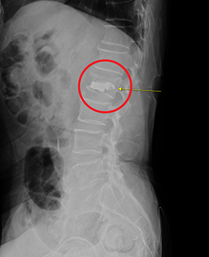 수술 후 X-ray — 골(뼈) 시멘트가 골절 부위에 채워진 모습