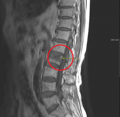 수술 전 MRI — 압박골절 부위 표시