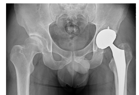 인공고관절치환술 수술 후 X-ray