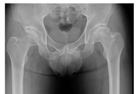 인공고관절치환술 수술 전 X-ray
