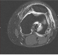 수술 전 MRI — 전방십자인대 파열 확인