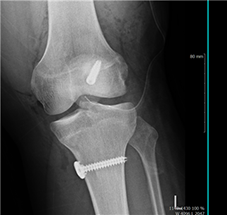 수술 후 X-ray — 재건 인대 고정 상태 확인