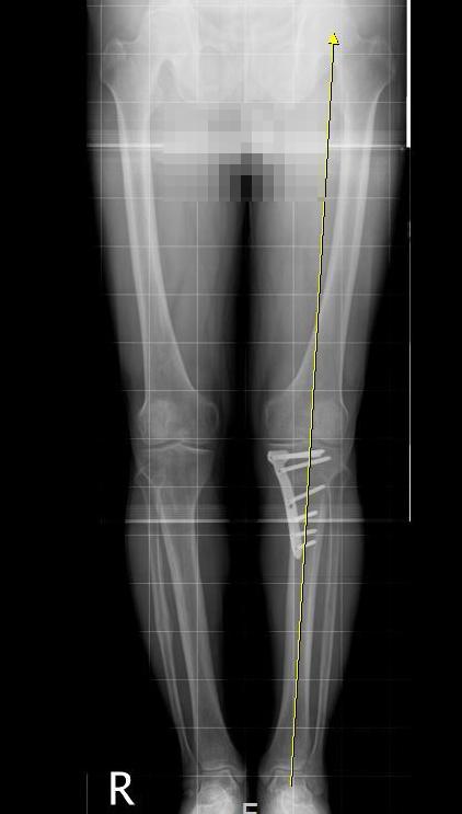 근위경골절골술 수술 후 하지 전장 X-ray