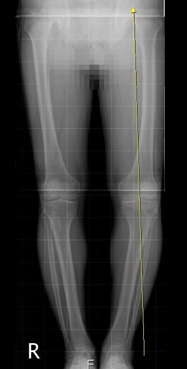 오다리 변형 수술 전 하지 전장 X-ray