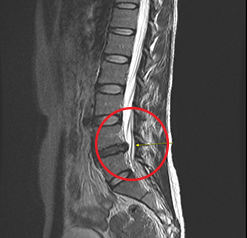 척추내시경술 시술 전 MRI, 디스크 탈출 부위 표시