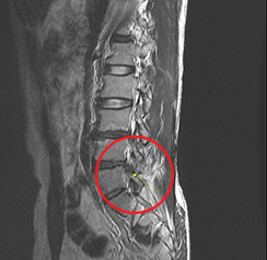 요추 디스크 탈출 MRI, 신경압박 부위 표시