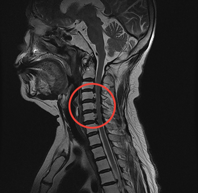 경추 후궁성형술 수술 전 MRI, 신경압박 부위 표시