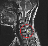 신경성형술 치료 사례 MRI, 경추 신경 눌림 부위 표시