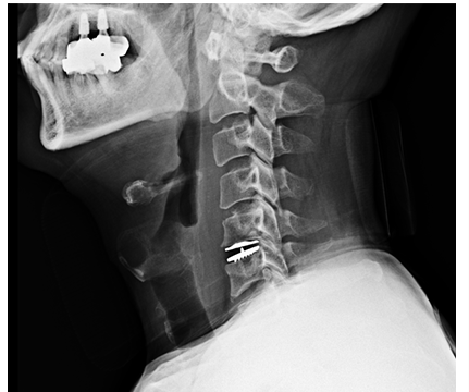 경추 인공디스크 치환술 수술 후 X-ray