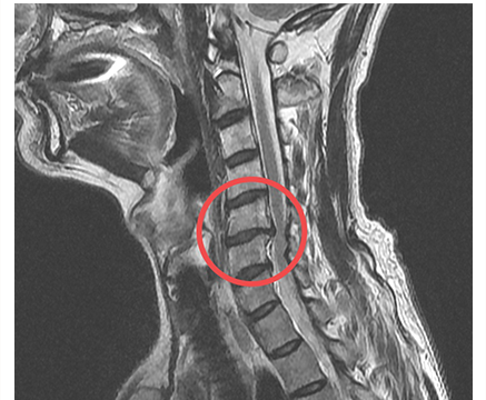 경추 인공디스크 치환술 수술 전 MRI