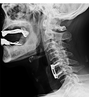 수술 후 X-ray — 경추뼈 고정 확인