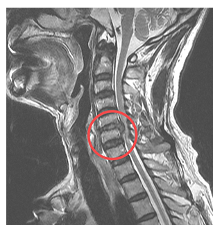 수술 전 MRI — 경추 신경압박 부위 표시