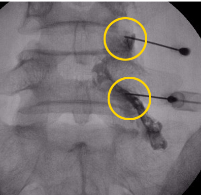 신경차단술 시술 중 투시(X-ray) 영상