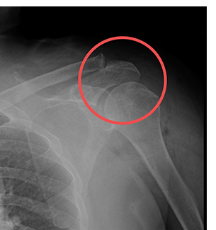 견봉성형술 수술 후 어깨 X-ray