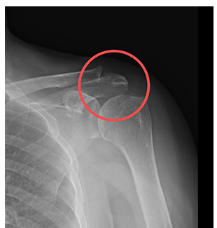 견봉성형술 수술 전 어깨 X-ray