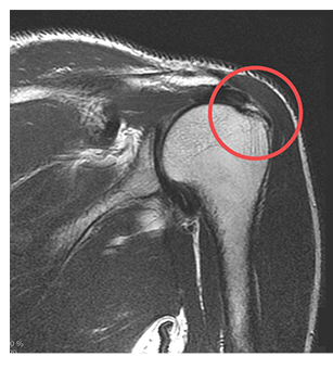 수술 전 MRI — 파열된 힘줄 부위 표시