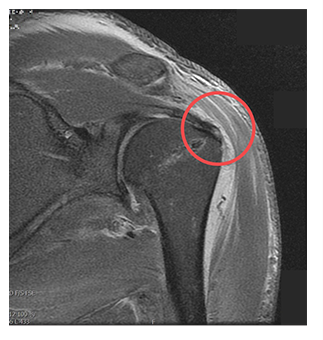 수술 후 MRI — 봉합된 힘줄 확인