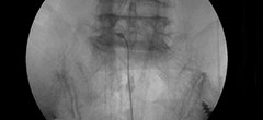 풍선확장술 시술 당시 투시(X-ray) 영상