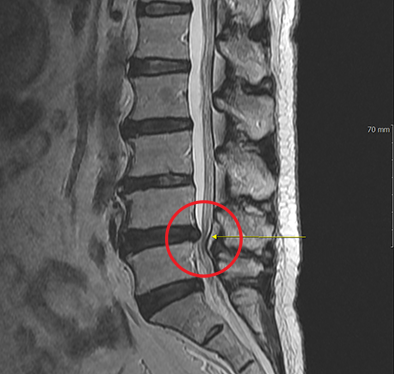 추간공확장술 수술 전 MRI, 신경관 협착 부위 표시